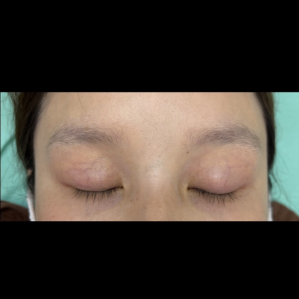 before画像