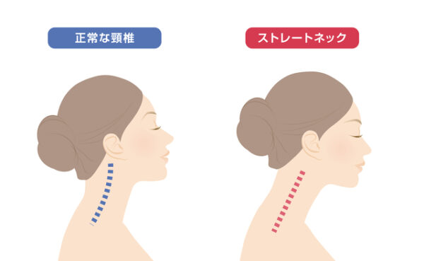 【整形外科医監修】ストレートネックとは？原因・症状・治療・予防エクササイズまで解説