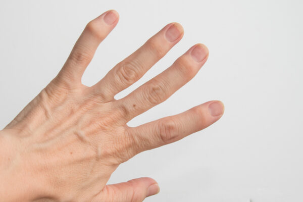 ヘバーデン結節の痛みが改善しない方へ|原因・対処法・受診の目安