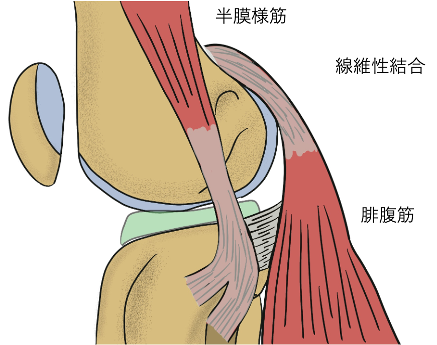 半膜様筋の痛み 